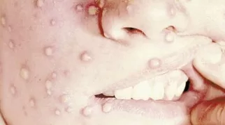 الصحة ترفع «حالة الطوارئ»..بالموانئ والمنافذ البرية والبحرية: «جدرى القرود» يهاجم العالم..و«مصر آمنة»