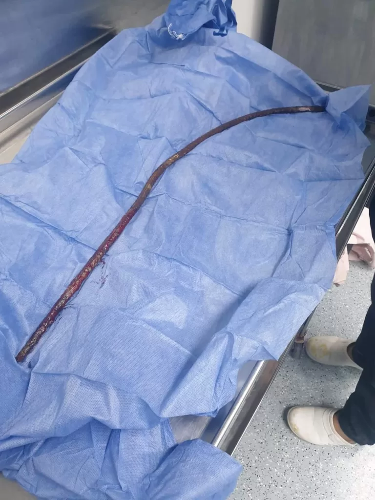 أطباء بني سويف ينجحون في جراحة معقدة لاستخراج سيخ حديدي من فخذ طفل 2 - جريدة الجمهورية WhatsApp Image 2024 09 21 at 1.58.39 PM - جريدة الجمهورية