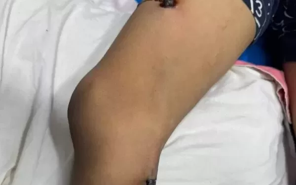 أطباء بني سويف ينجحون في جراحة معقدة لاستخراج سيخ حديدي من فخذ طفل 1 - جريدة الجمهورية فرحة لا توصف تملأ المدارس في أول يوم دراسي بالجيزة