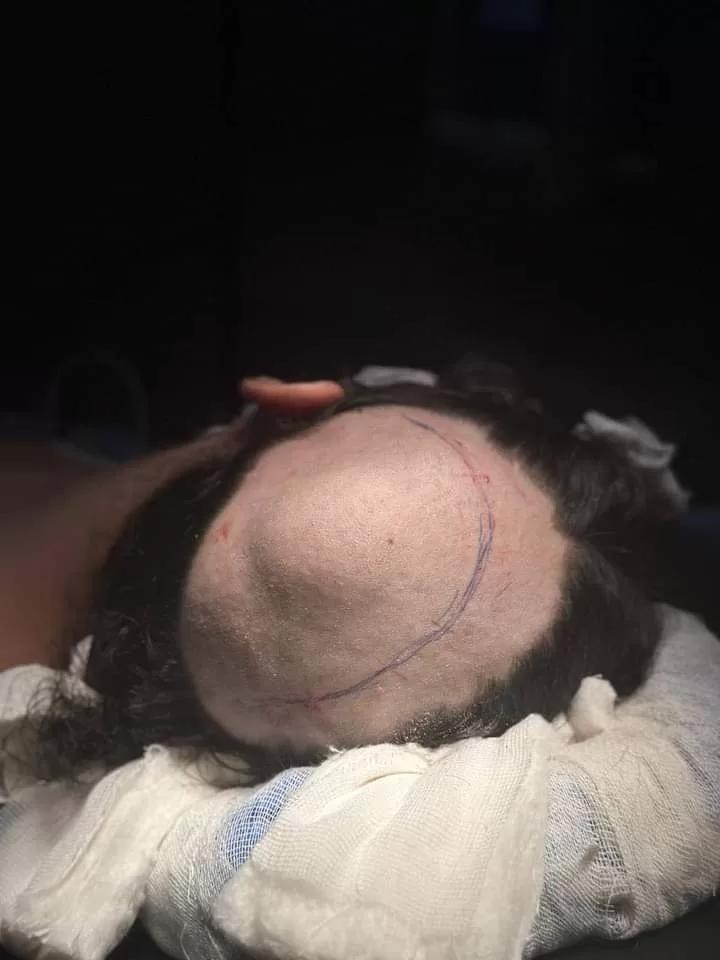 جراحة متطورة بتقنية الطباعة ثلاثية الأبعاد تُعيد الشكل الطبيعي لجمجمة فتاة بشبين الكوم 2 - جريدة الجمهورية WhatsApp Image 2024 10 20 at 7.42.16 AM jpeg - جريدة الجمهورية