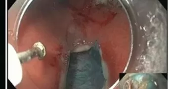 طب حلوان تحقق سبقًا علميًا عالميًا في مجال المناظير