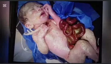 ميت غمر: فريق طبي يجري جراحة دقيقة وينقذ «رضيعًا» بأمعاء خارج الجسم 2 - جريدة الجمهورية 3 23 - جريدة الجمهورية