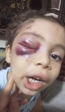 حادث مؤلم: كلب ضال يعقر «عين طفل» بالعاشر من رمضان 1 - جريدة الجمهورية حادث مؤلم: كلب ضال يعقر «عين طفل» بالعاشر من رمضان