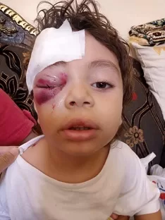 حادث مؤلم: كلب ضال يعقر «عين طفل» بالعاشر من رمضان 2 - جريدة الجمهورية 7 68 - جريدة الجمهورية
