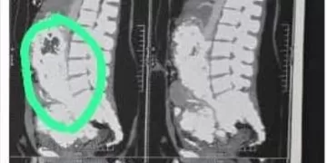 «مركز أورام سوهاج» ينجح في استئصال ورم نادر بحجم «16سم» لفتاة كان يهدد حياتها