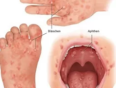 رصد 4 حالات بفيروس HFMD بتعليم الجيزة