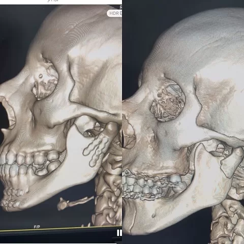 فريق طبي بمستشفى «شربين» يحقق إنجازًا جديدًا في جراحات الوجه والفكين 2 - جريدة الجمهورية 1 74 - جريدة الجمهورية