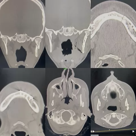 فريق طبي بمستشفى «شربين» يحقق إنجازًا جديدًا في جراحات الوجه والفكين 4 - جريدة الجمهورية 3 44 - جريدة الجمهورية