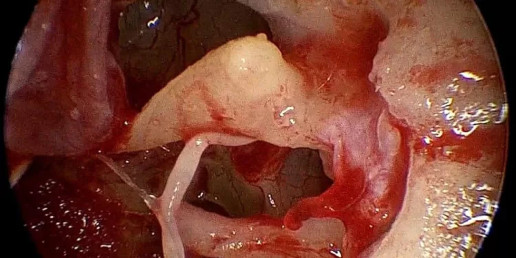 سبق طبي جديد لجامعة سوهاج.. استئصال ورم وعائي بالأذن الوسطى بالمنظار دون فتح جراحي