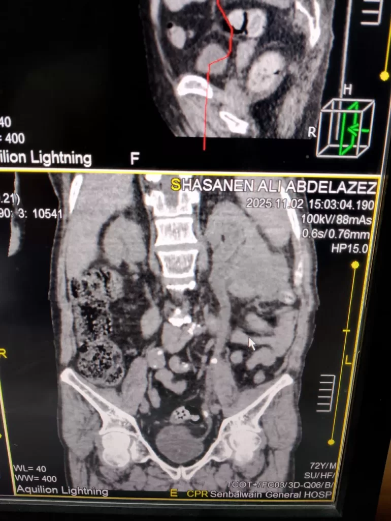إنقاذ مريض يبلغ من العمر 75 عامًا من آلام مجهولة بمستشفى السنبلاوين 2 - جريدة الجمهورية WhatsApp Image 2025 11 03 at 4.48.30 PM 2 - جريدة الجمهورية