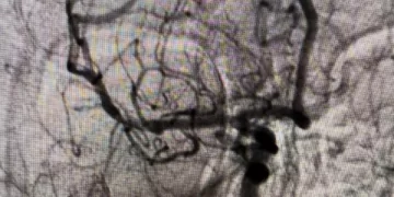 إنقاذ 4 حالات حرجة.. وحدات السكتات الدماغية بالدقهلية تسجل نجاحات متوالية