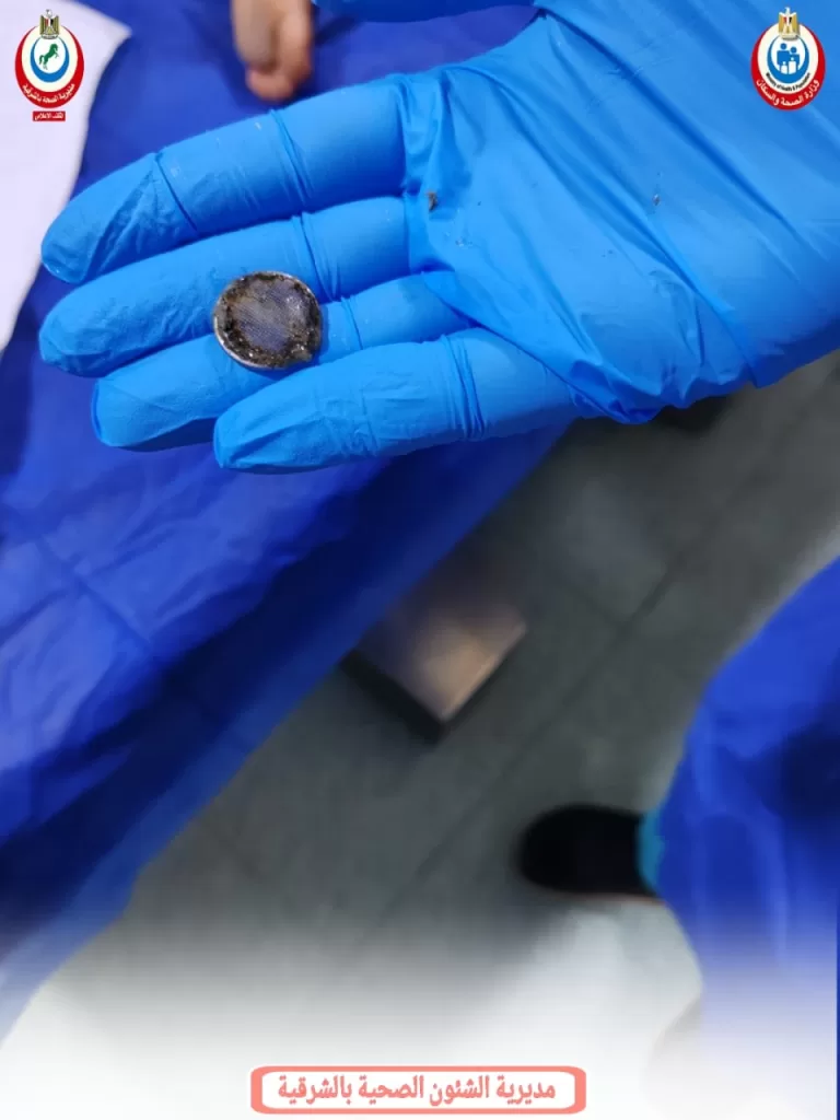 استخراج أجسام معدنية خطرة بنجاح من أمعاء 3 أطفال بالشرقية 3 - جريدة الجمهورية WhatsApp Image 2025 12 09 at 19.37.33 7ebae09b - جريدة الجمهورية