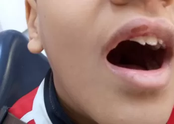 مهارة الأطباء تعيد «ابتسامة ياسين»: مستشفى الشروق المركزي تعالج تهشم أسنان طفل سقط من سرير علوي 4 - جريدة الجمهورية مهارة الأطباء تعيد «ابتسامة ياسين»: مستشفى الشروق المركزي تعالج تهشم أسنان طفل سقط من سرير علوي