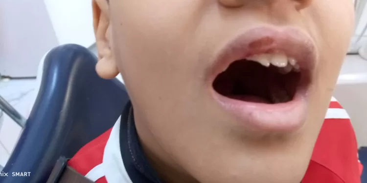 مهارة الأطباء تعيد «ابتسامة ياسين»: مستشفى الشروق المركزي تعالج تهشم أسنان طفل سقط من سرير علوي