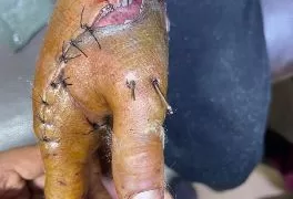 في عملية استغرقت 6 ساعات.. «طب سوهاج» تنجح في إعادة زرع «إبهام مبتور» لشاب