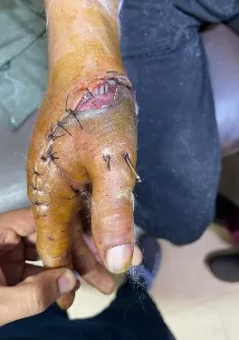 في عملية استغرقت 6 ساعات.. «طب سوهاج» تنجح في إعادة زرع «إبهام مبتور» لشاب