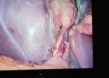 نجاح عملية إزالة حصوات القنوات المرارية بإستخدام منظار متقدم