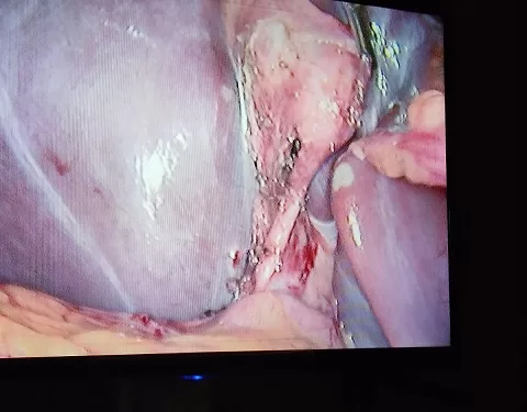 نجاح عملية إزالة حصوات القنوات المرارية بإستخدام منظار متقدم