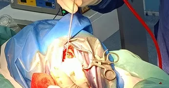 نجاح جراحة دقيقة باستخدام «جراحة اليقظة» بمستشفى أجا