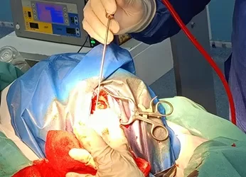 نجاح جراحة دقيقة باستخدام «جراحة اليقظة» بمستشفى أجا