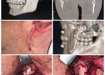 اليوبيل الذهبي للنجاح.. مستشفى شربين المركزي يُتم العملية رقم 50 في جراحة الوجه والفكين