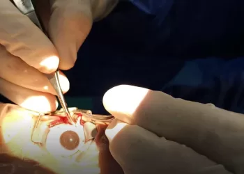 مجمع السويس الطبي يحقق نجاحًا جديدًا في جراحات تصحيح الحول للأطفال 3 - جريدة الجمهورية مجمع السويس الطبي يحقق نجاحًا جديدًا في جراحات تصحيح الحول للأطفال