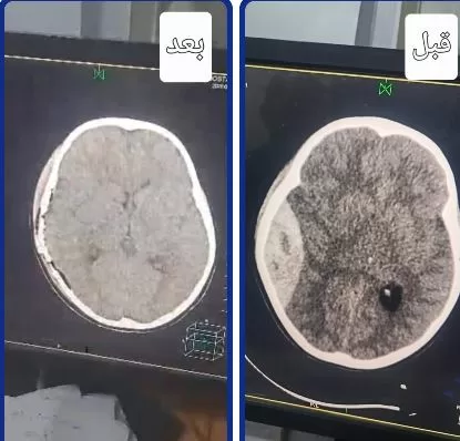 فريق طبي بمستشفى أجا المركزي ينقذ حياة طفل بعد جراحتين دقيقتين في المخ 2 - جريدة الجمهورية 1 124 - جريدة الجمهورية