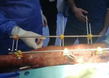 إنجاز طبي في «الفيوم العام»..إنقاذ رضيعة من ورم نادر ونجاح جراحة دقيقة لإنقاذ ساق مصاب من البتر