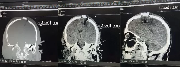 بجراحة دقيقة.. انقاذ مريضاً من إصابة خطيرة بالمخ بمستشفى ميت غمر 3 - جريدة الجمهورية 5 39 - جريدة الجمهورية