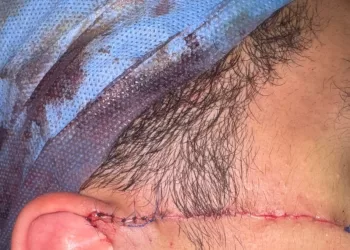 على باب المدرسة.. طالب يشج وجه زميله بـ«كتر»