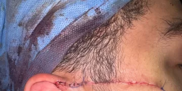 على باب المدرسة.. طالب يشج وجه زميله بـ«كتر»
