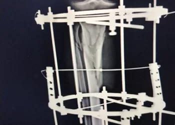 إنقاذ رجل مريض من البتر بعد جراحة دقيقة بمستشفى أبو حماد المركزي 7 - جريدة الجمهورية إنقاذ رجل مريض من البتر بعد جراحة دقيقة بمستشفى أبو حماد المركزي