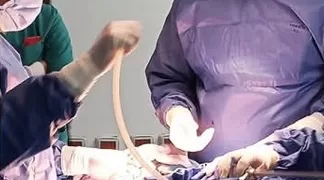 مجمع السويس الطبي ينقذ شابة من مضاعفات اختناق المبيض بتدخل جراحي عاجل