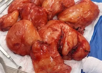 استئصال ورم ضخم يزن ٣ كيلو جرامات من التجويف الصدري لطفلة بالشرقية